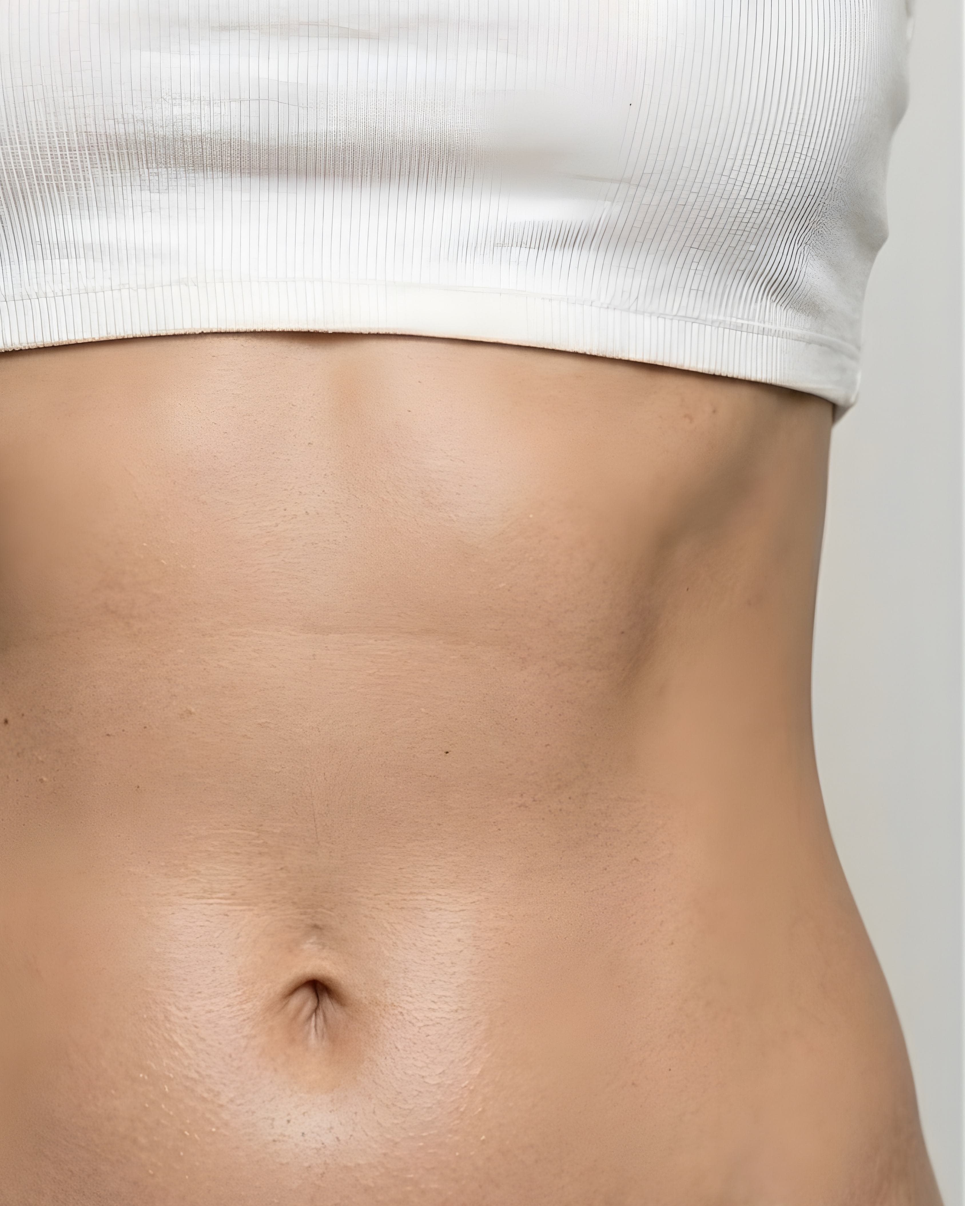 Alles wat u moet weten over een liposuctie